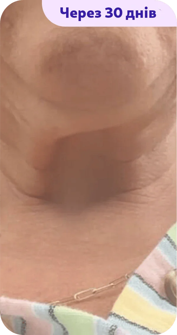 A close-up image of a person's neck and chin area featuring subtle skin texture. The background shows a portion of a striped garment. In the corner, there is the text "After 30 days" in purple. The skin appears to have improved in texture or firmness over a 30-day period, conveying a potential result of a skincare treatment or regimen.