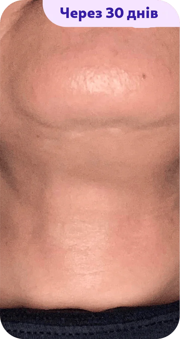 Close-up view of a bare skin area, focusing on the chin and neck region, showing smooth and even-toned skin. The image highlights a noticeable change after a 30-day period, indicating potential improvement in skin texture or appearance. There is minimal visible detail such as pores or blemishes, suggesting a polished look. The image is framed with a purple text label in the top corner stating "After 30 days."