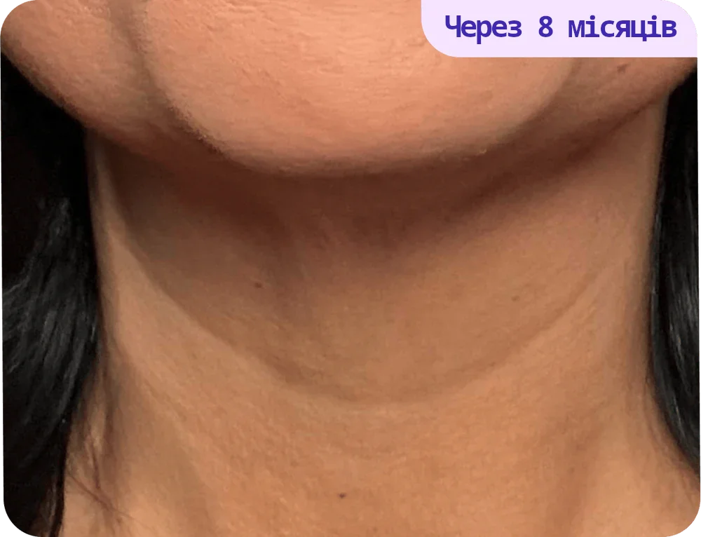 An image showing the lower part of a person's neck and chin area, highlighting skin texture. The skin appears smooth and even-toned, suggesting improvement over time. There are no visible blemishes or irregularities. In the top right corner, there is a text overlay stating "After 8 weeks," indicating a time frame for skin treatment or regimen results. The background is neutral, allowing the focus to remain on the skin's appearance.