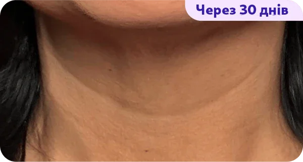An image demonstrating the skin on a person's neck, labeled "After 8 weeks." The neck appears smooth and healthy, with even skin tone and minimal visible pores. The background is blurred, drawing attention to the skin's texture and condition. The overall appearance suggests an improvement in skin health.