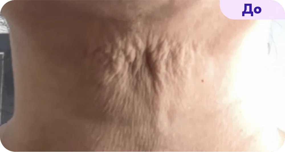 Close-up view of the neck showing skin texture. The skin appears loose and wrinkled, with noticeable creases and indentations in the middle area. The lighting enhances the visibility of these skin features. The image is labeled "Before" at the top right corner, suggesting it is part of a comparison or treatment process.
