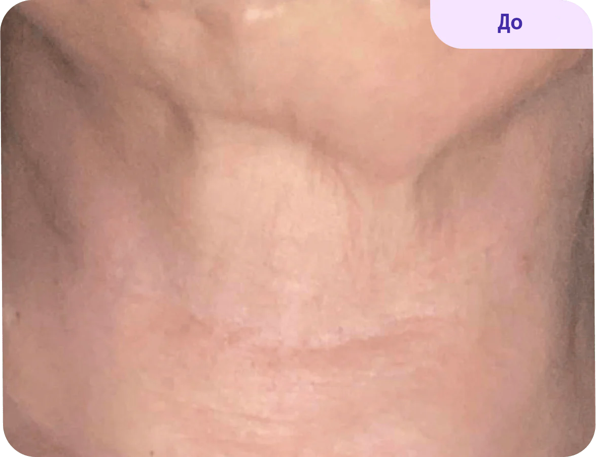 Close-up image of a neck area showing skin texture in a natural state. The skin appears smooth with subtle lines and no visible imperfections. The background is a soft, neutral tone, highlighting the subject's skin. A label in the top right corner reads "Before," indicating this is a preliminary image possibly related to a skin treatment or procedure.