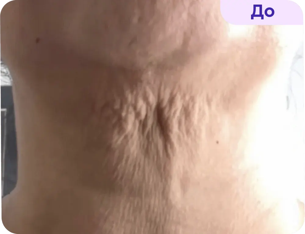 Close-up view of the nape of a person’s neck, showing skin texture and subtle wrinkles. The skin appears slightly loose, with lines and indentations visible. A label in the upper right corner reads "Before," indicating this is a comparative image in a skincare or rejuvenation context. The background is blurred, focusing attention on the neck area.