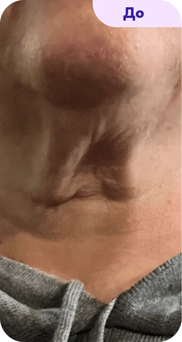 A close-up view of a person's neck and upper chest area, showing skin texture and folds. The skin appears to have some areas of shadow and light, highlighting the contours. The individual is wearing a gray hoodie, and the image is labeled "Before" in the top right corner. The focus is on the skin without any specific details about the person's identity or background.