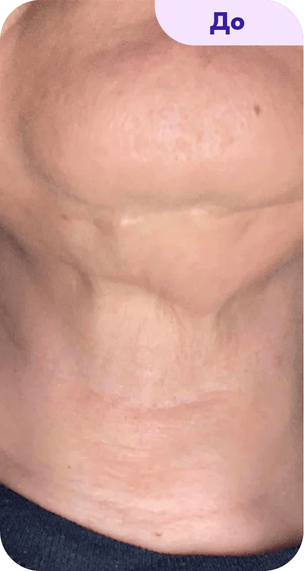 A close-up image of a person's neck showing skin texture and minor imperfections. The skin appears slightly wrinkled and uneven in tone, with visible lines and a matte finish. The image is labeled "Before" in the top right corner, indicating that it may be part of a comparison or progression series. The background is neutral, emphasizing the focus on the neck area.