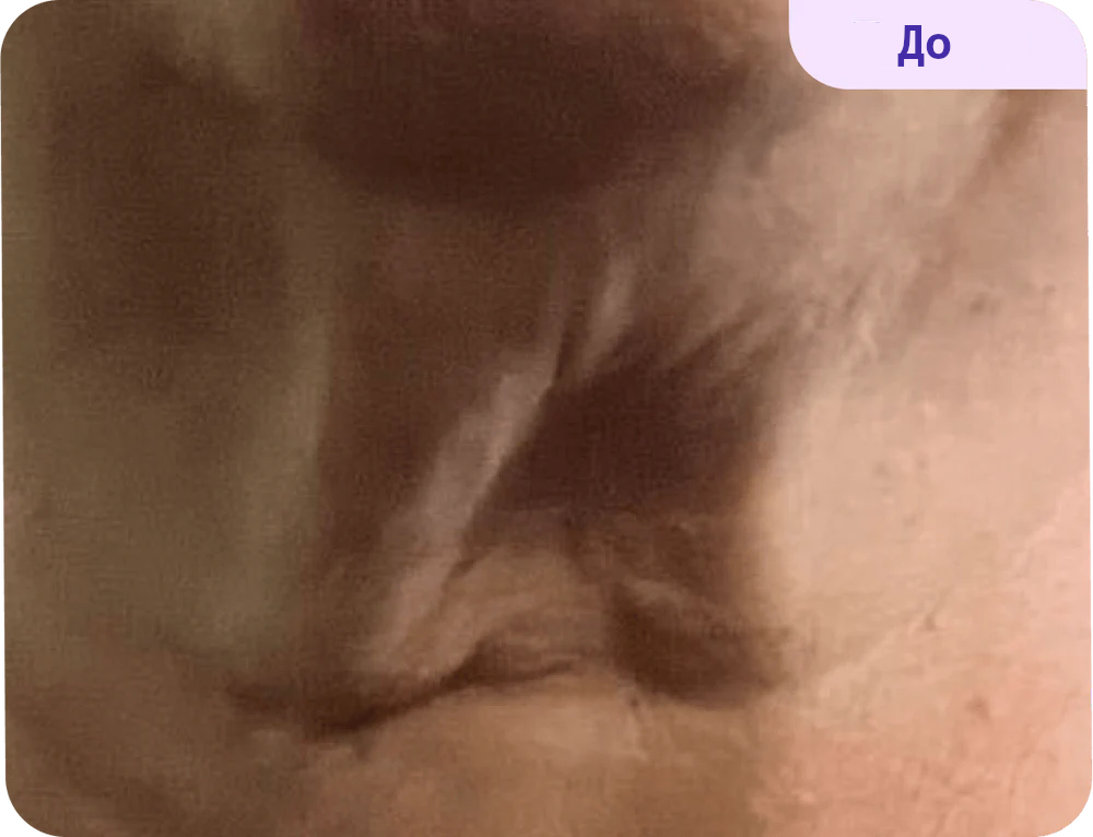 A close-up view showing skin texture and tones, with a focus on creases and folds. The image has a subtle, blurred appearance, emphasizing the skin’s natural color variations. In the top corner, the word "Before" is displayed in a purple box.